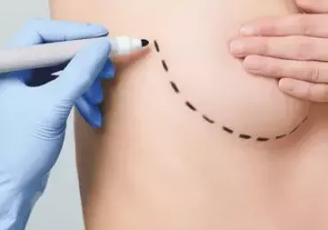 Аугментационная мастопексия: комплексный подход к красоте груди